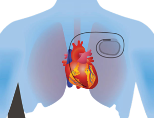 Pacemaker Implantation Doctor In Navi Mumbai | Dr.Rishi Bhargava